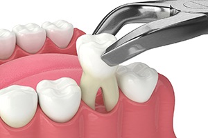 Digital image of a tooth being removed